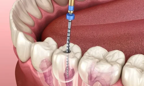 Root-Canal-Therapy