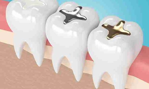composite-fillings-header